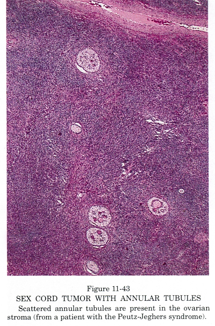 Pathology Outlines Sex Cord Tumor With Annular Tubules
