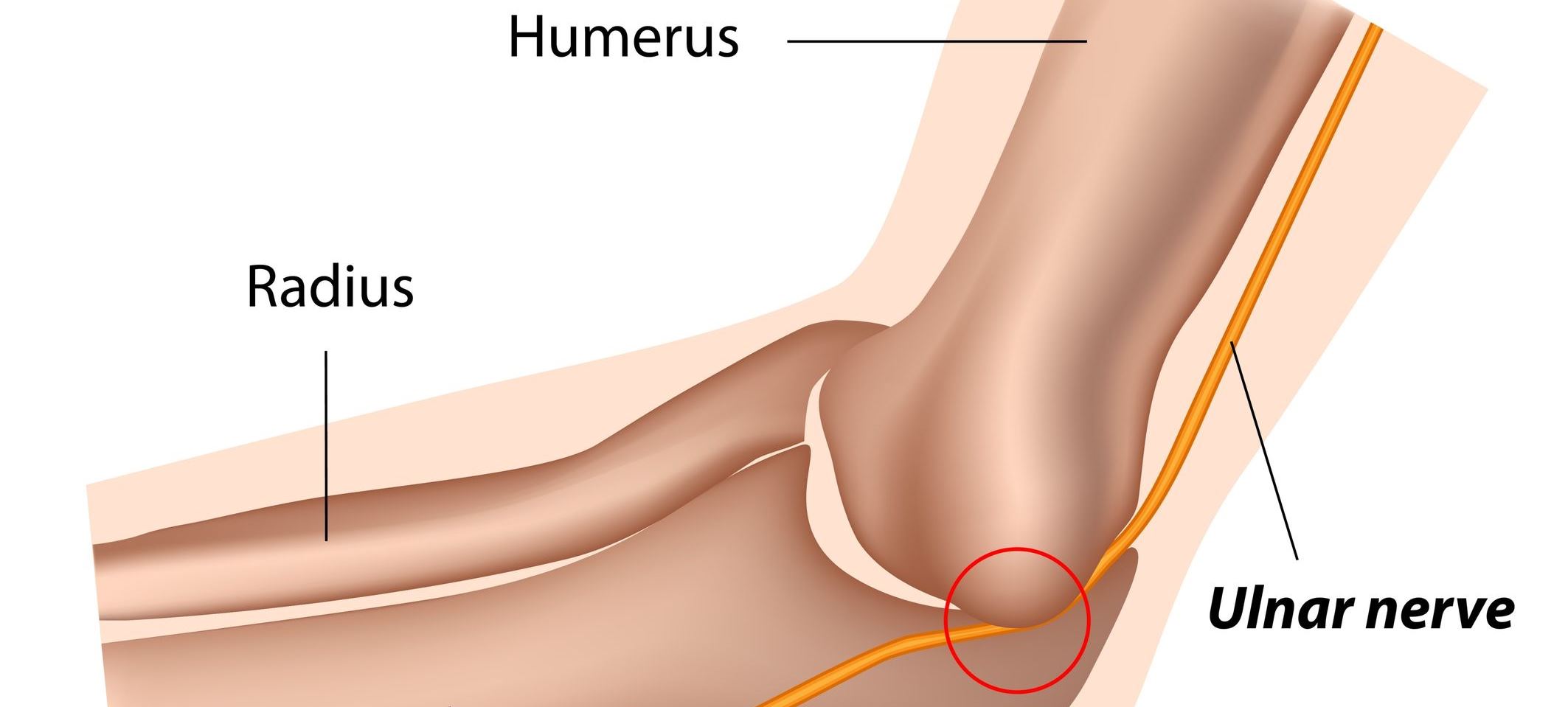 Ulnar Nerve Entrapment And Neck Pain Minneapolis Spine Doctor