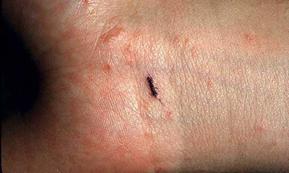 Scabies Rash Look Like And Causes6