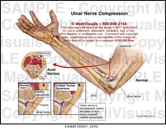 Ulnar Nerve Compression Medical Illustration Medivisuals