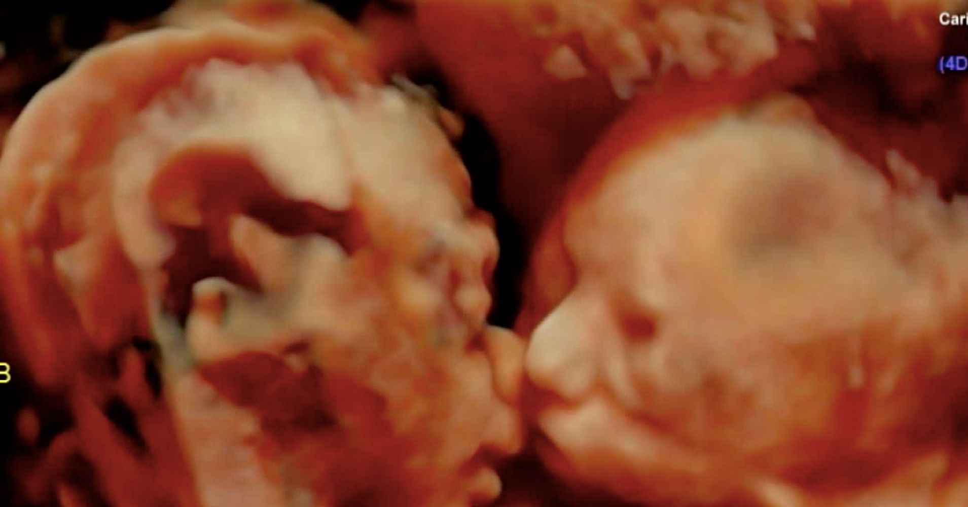 Amazing Ultrasound Shows Twins Sharing A Kiss In The Womb Huffpost