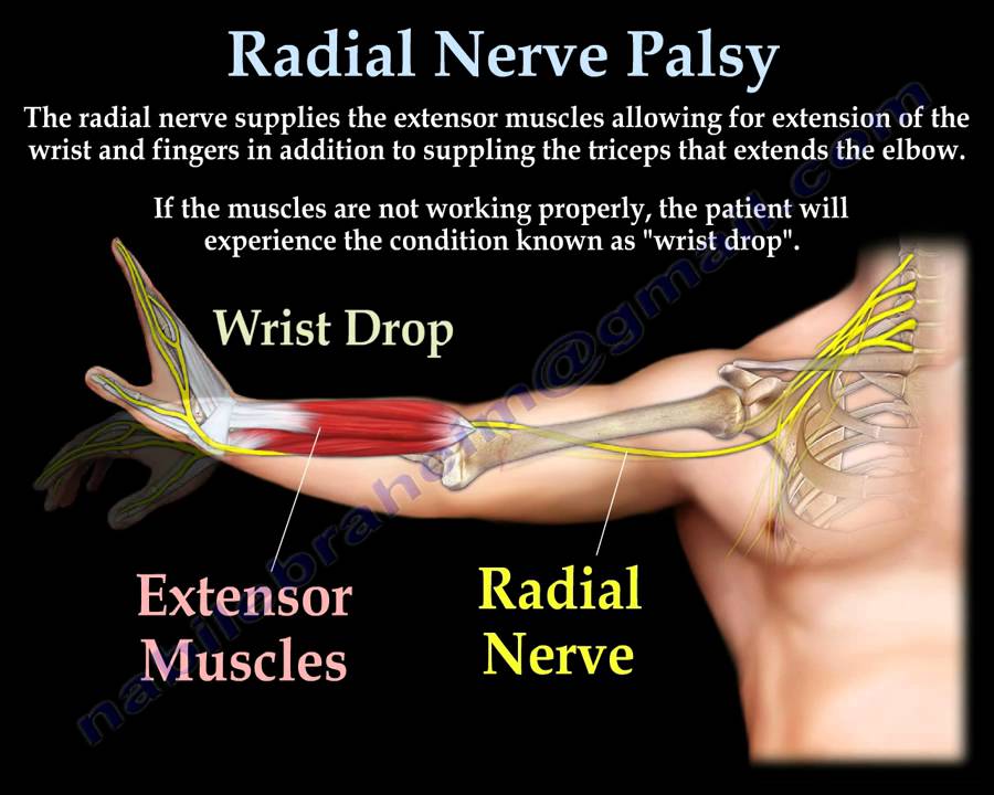 Vastral Physiotherapy Clinic Radial Nerve Palsy And Physiotherapy