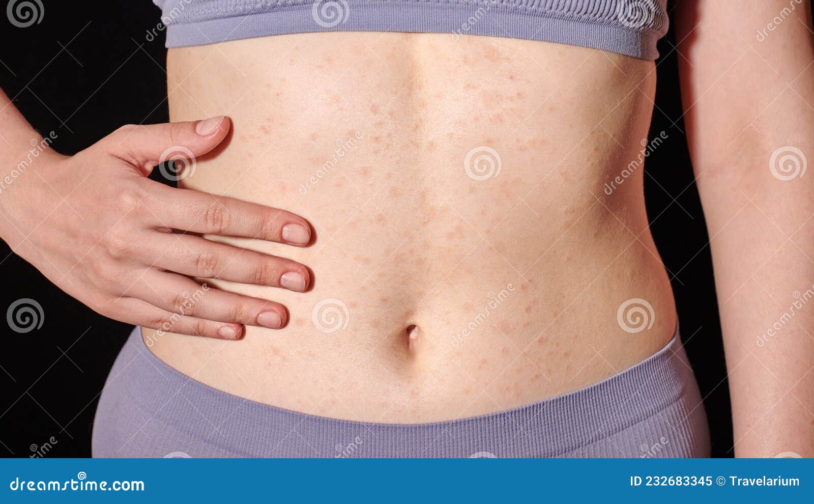 Red Allergic Rash On Stomach Skin Skin Allergy Atopic Dermatitis