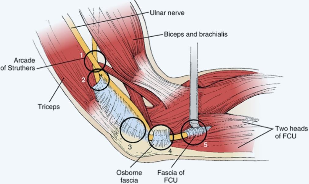 Cubital Tunnel Syndrome Hand Orthobullets