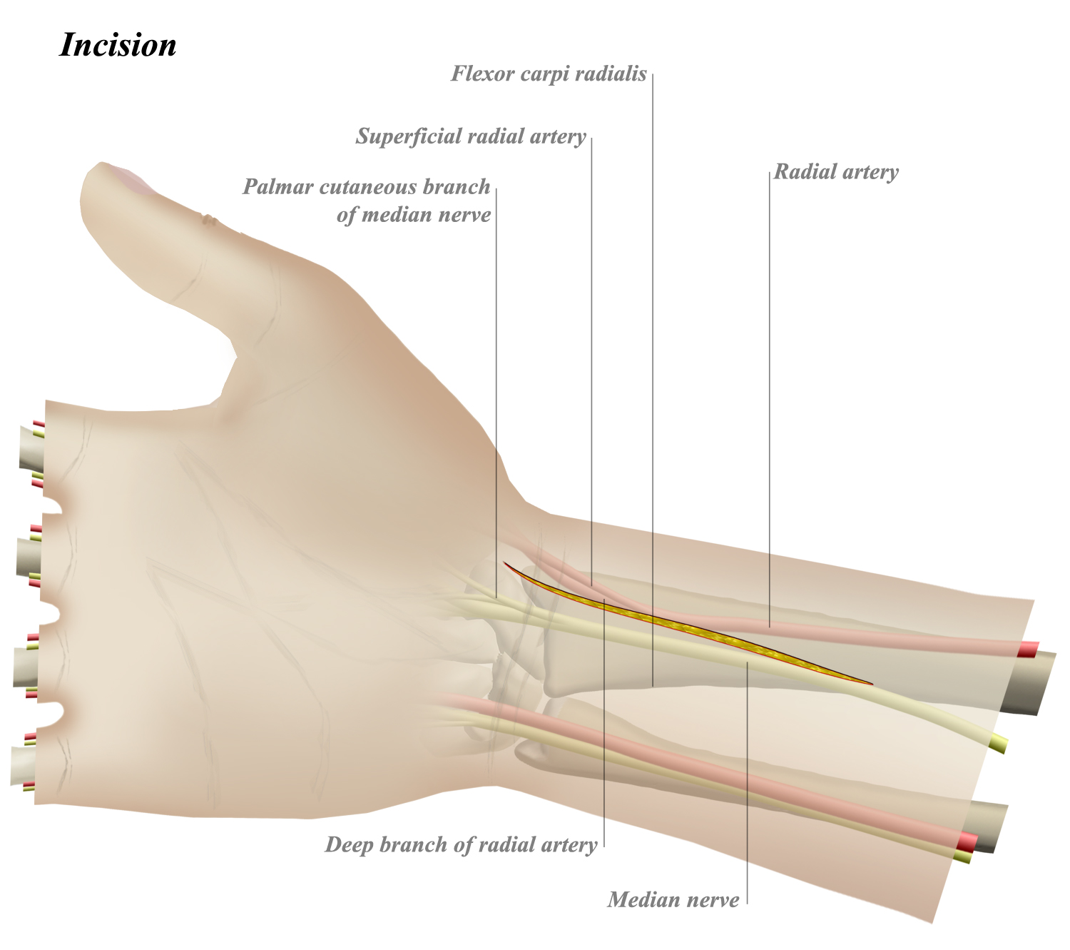 Fcr Approach To Distal Radius Approaches Orthobullets