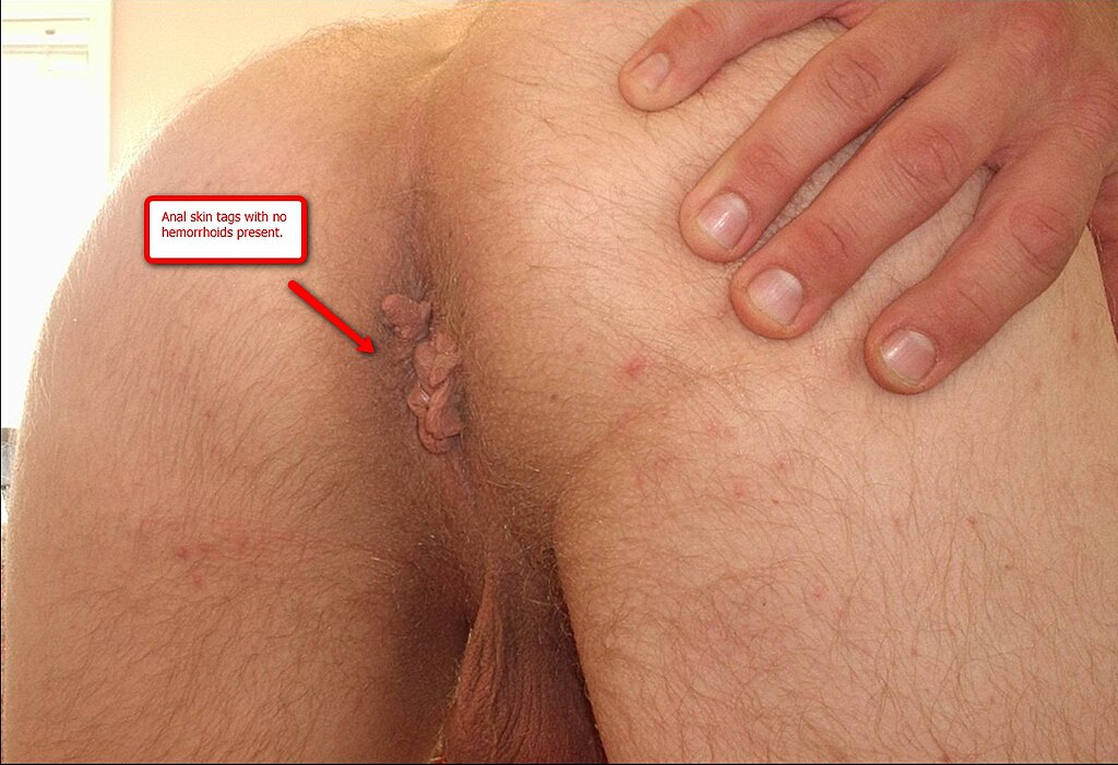 Fileanal Skin Tags Without Hemorrhoids Present