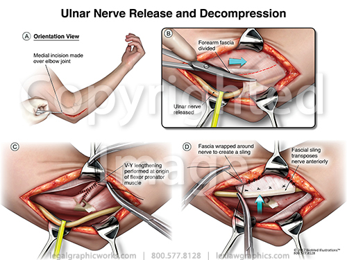 Ulnar Nerve Decompression Legal Graphicworks