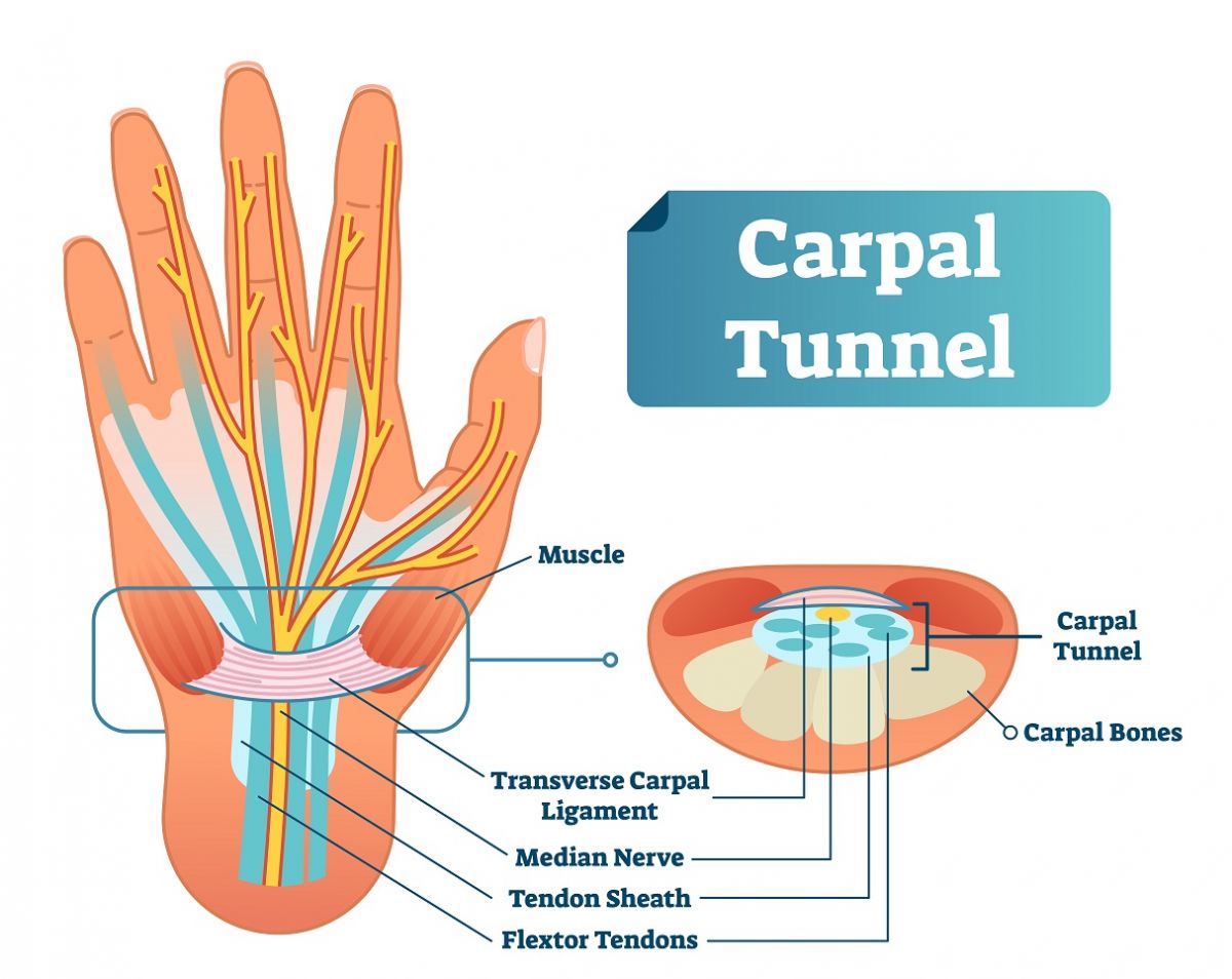 Carpal Tunnel Syndrome What Is It Lifemark