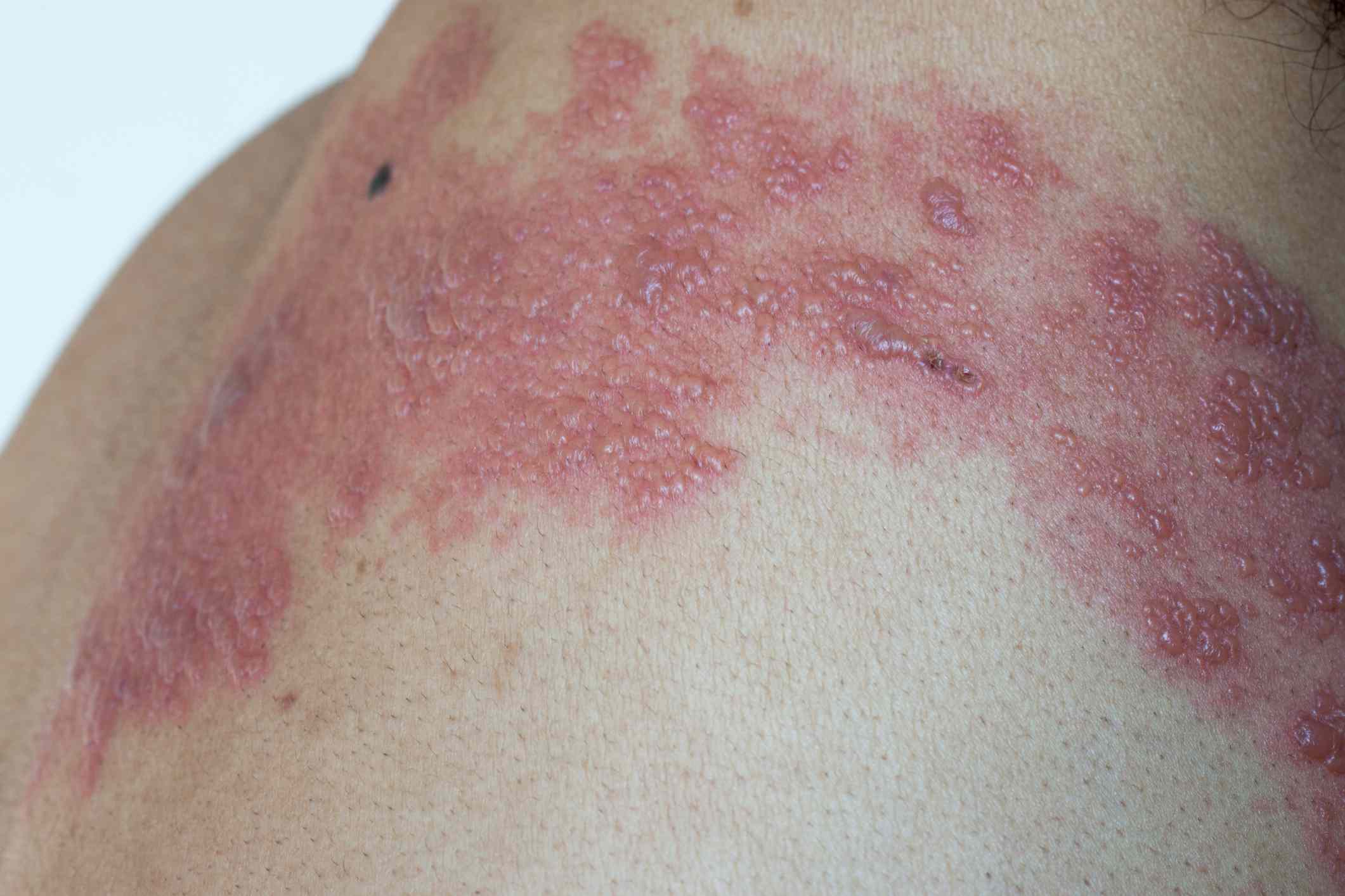 What Does Shingles Look Like Shingles Rash Pictures