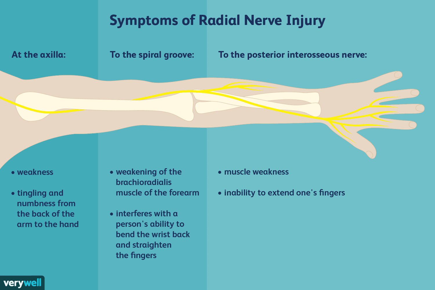 Instant Anatomy Upper Limb Nerves Nerve Lesions Radial In Forearm
