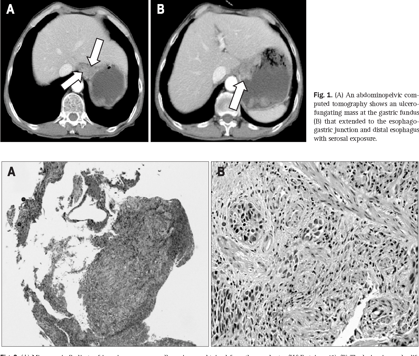 Figure 1 From A Case Of Synchronous Squamous Cell Carcinoma In The