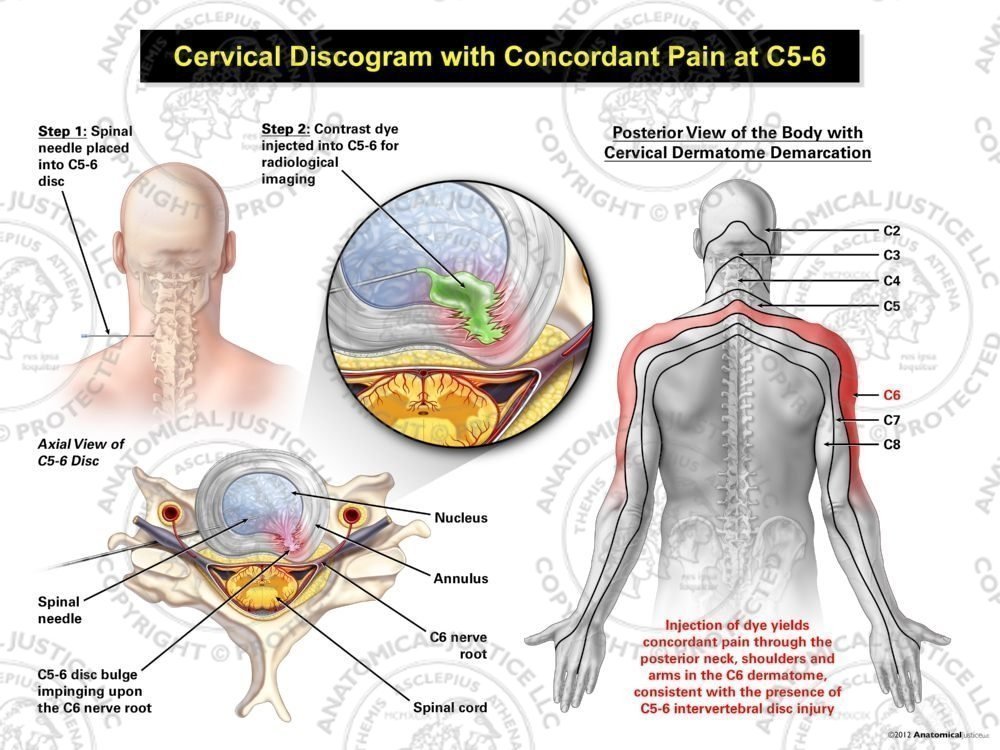 C5 C6 Bulging Disc Symptoms Cervical Radiculopathy Hand And Arm Pain