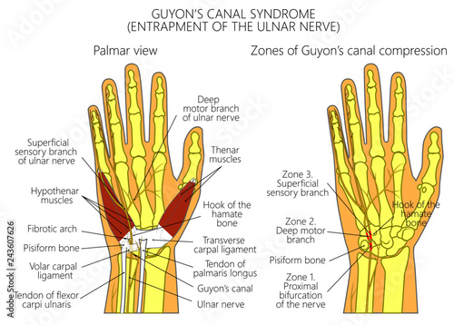 Guyon Canal Anatomy