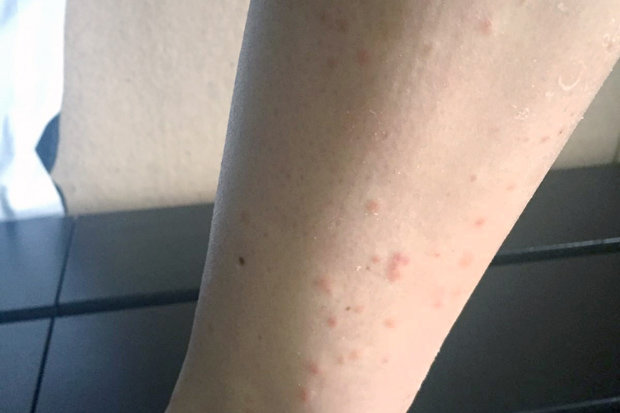 Young Woman Finds Shaving Rash Is Deadly Cancer Daily Star
