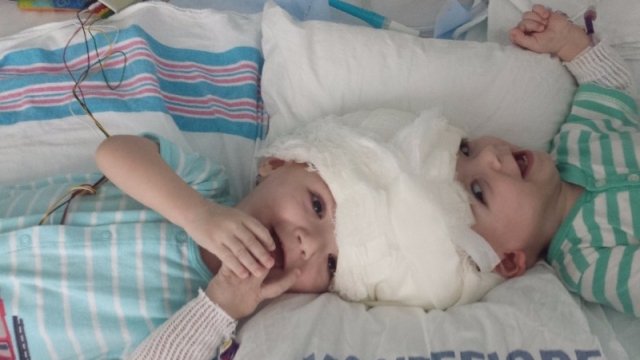 Conjoined Twins Finally Separated During Rare Surgery