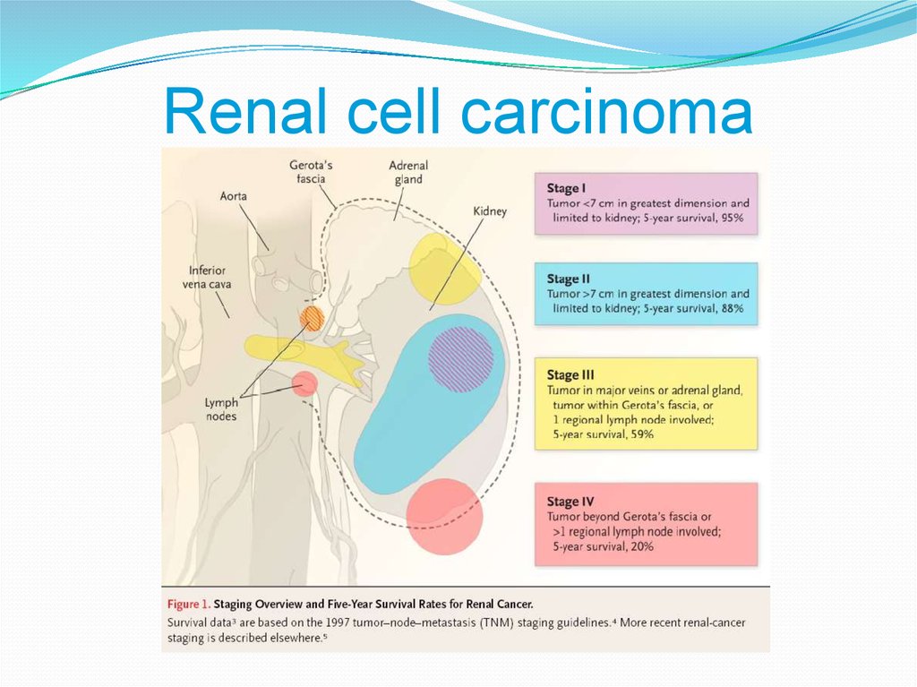 Gu Tumors Renal Cell Carcinoma презентация онлайн