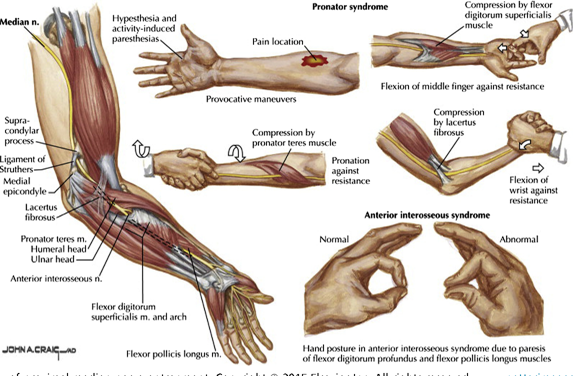 Anterior Interosseous Nerve Palsy As A Complication Of Proximal Humerus