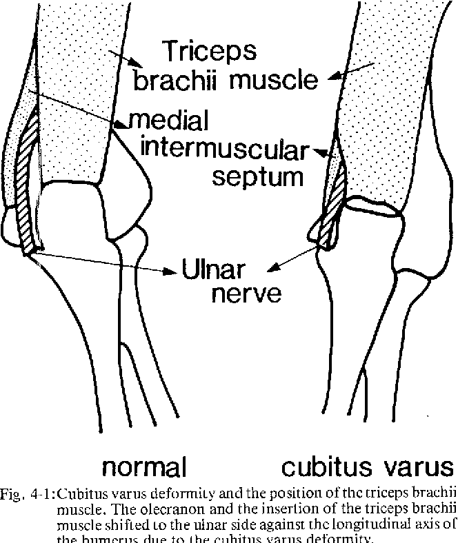 Figure 41 From Tardy Ulnar Nerve Palsy Caused By Cubitus Varus
