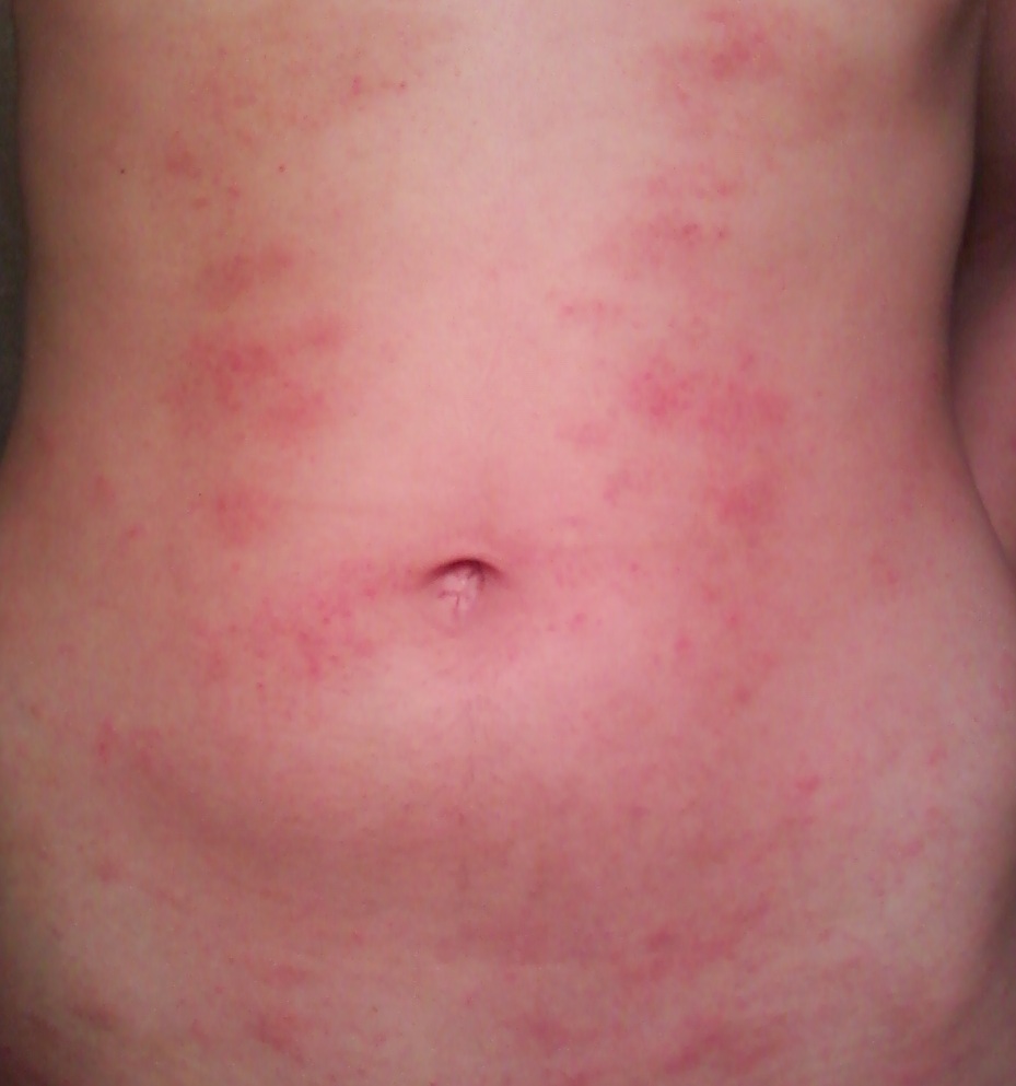 Eczema On Stomach Pictures Photos