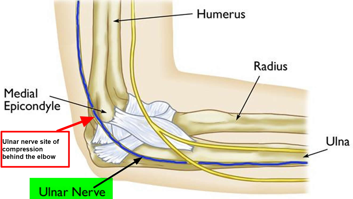 Ulnar Neuropathy Causes Symptoms Diagnosis Treatment And Exercises