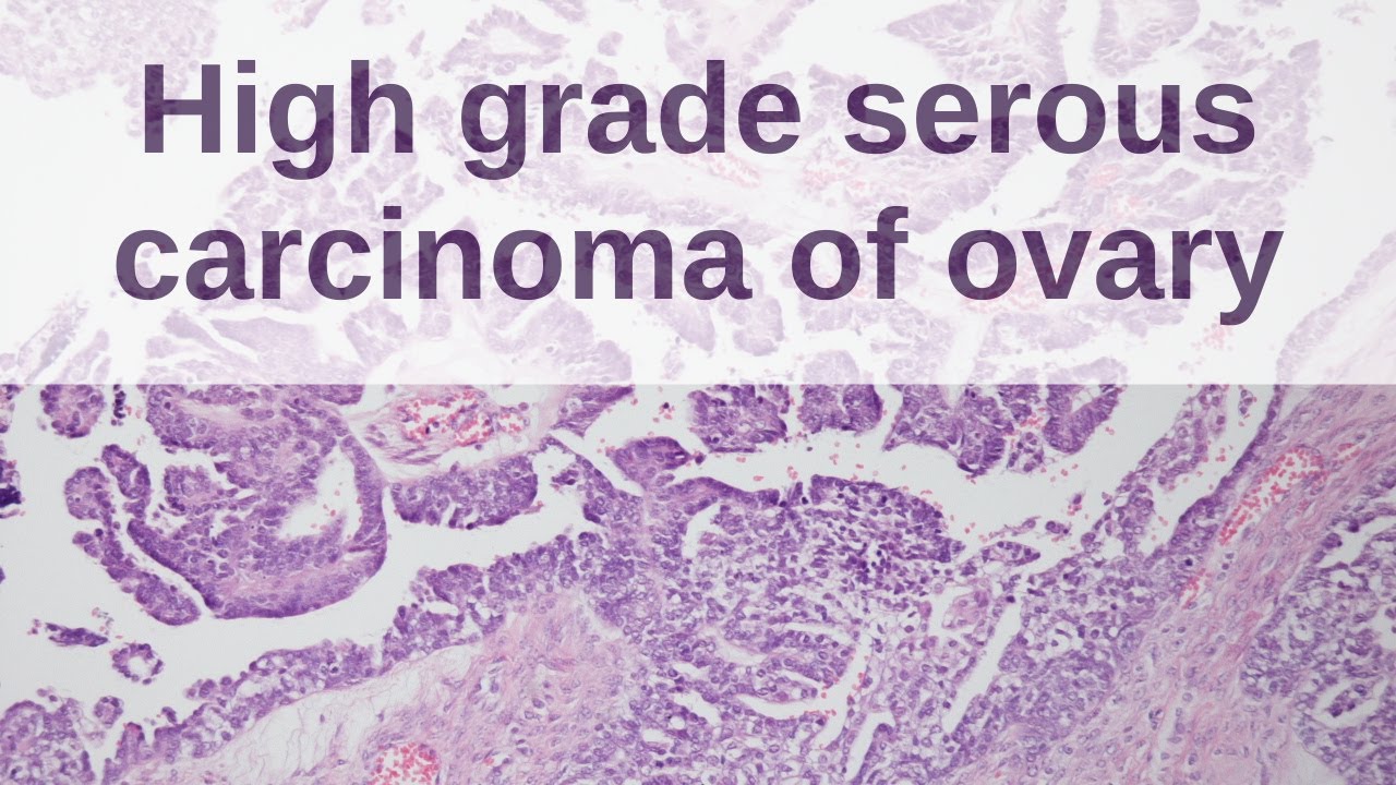 High Grade Serous Carcinoma Of Ovary Pathology Mini Tutorial Youtube