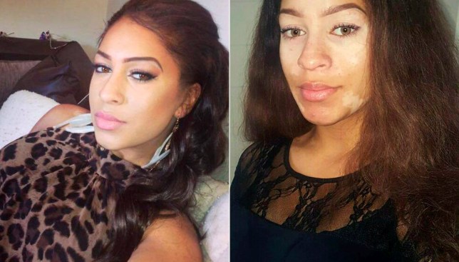 Woman With Vitiligo Launches Make Up Brand After Hiding