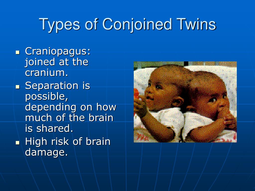 Ppt Health Effects Of The Separation Of Conjoined Twins Powerpoint