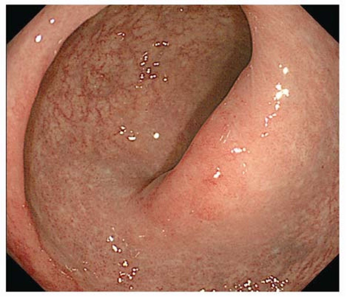 Rectal Mucosal Prolapse Syndrome As An Unusual
