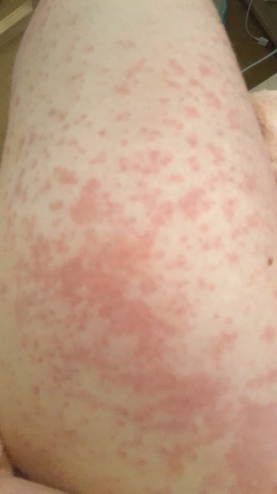 First Time Mums Body Was Covered In Rashes After Having An Allergic