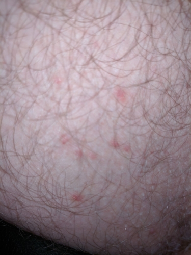 Developed A Rash On Inner Thighs Hoping Its Not Herpes Genital