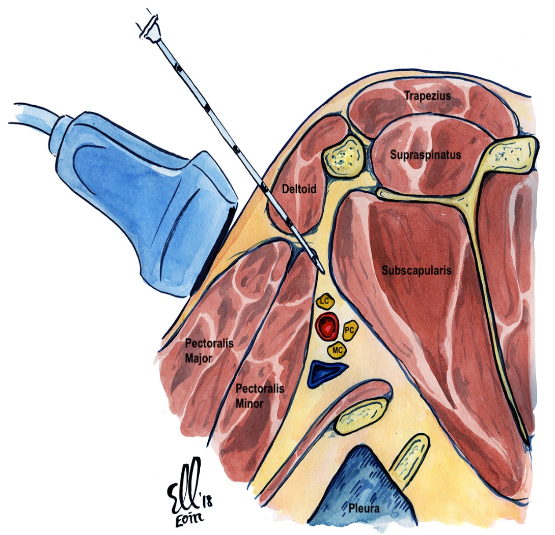 Ultrasound Guided Infraclavicular Brachial Plexus Block Wfsa Resources