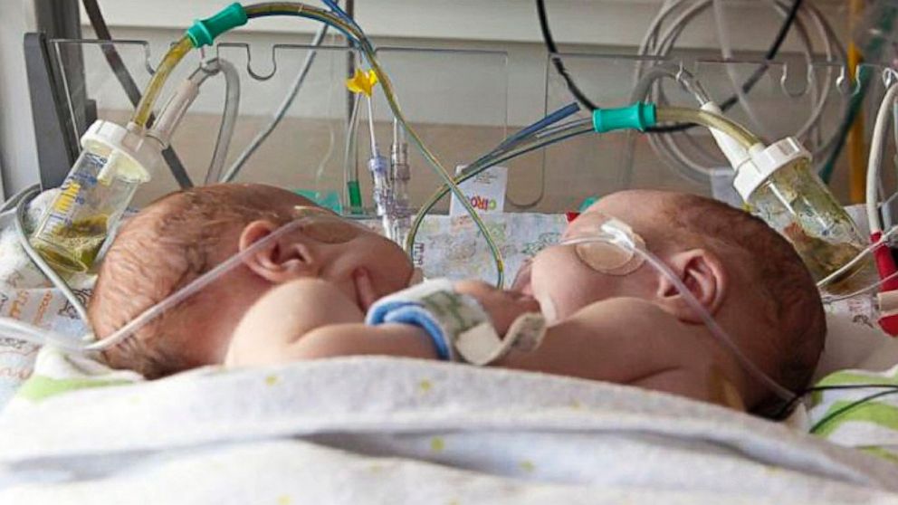 Conjoined Twins Are Successfully Separated In Dallas Abc News