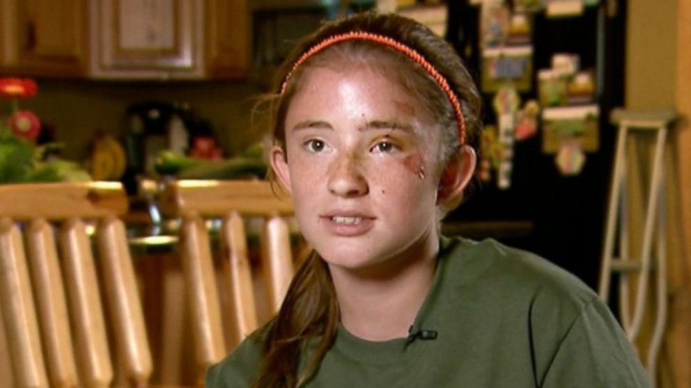 12 Year Old Girl Thought She Was A Goner In Bear Attack