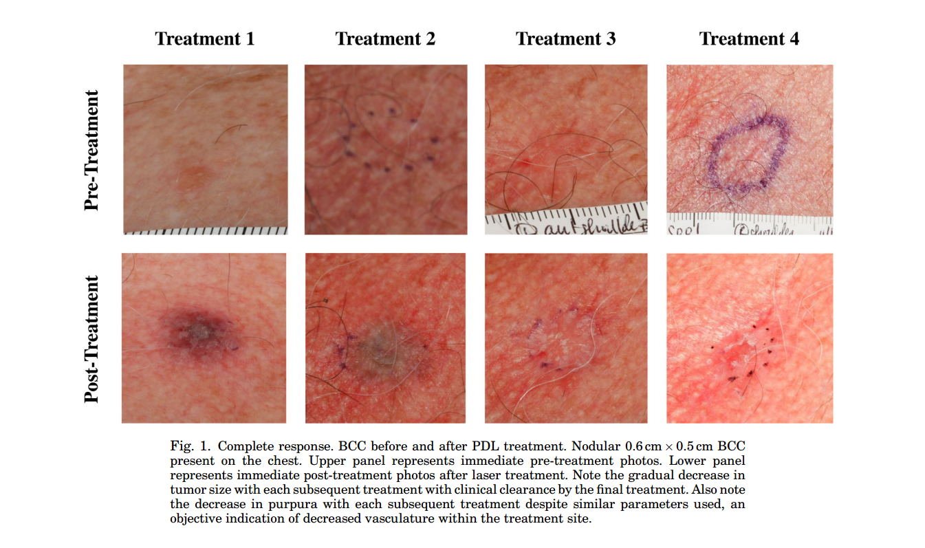 New Non Invasive Treatment Of Basal Cell Carcinoma