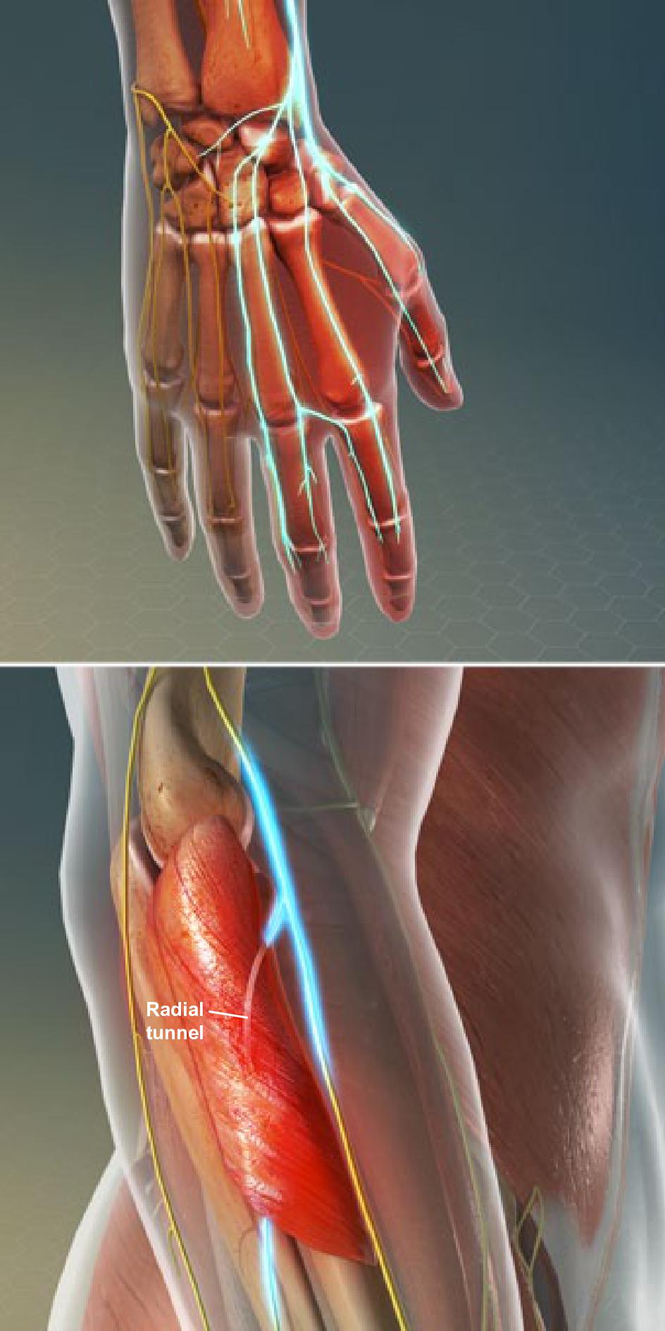 Radial Tunnel Syndrome Entrapment Of The Radial Nerve